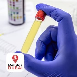 Bilharziasis Urine Test