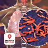 Mycobacterium Tuberculosis PCR Test
