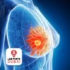 Oncotype DX Breast Cancer Test