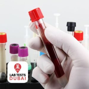 Protein Immunoelectrophoresis Test